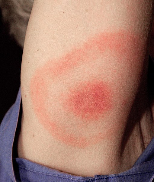 Erythema migrans