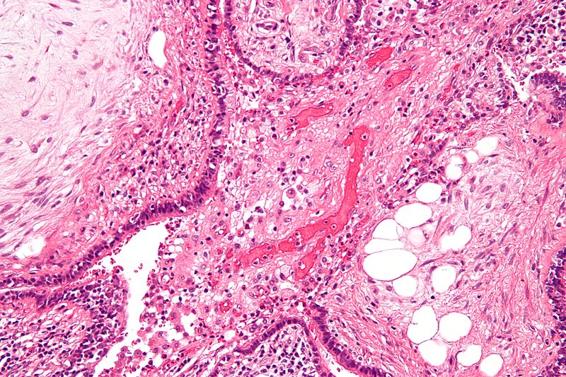 Hamartom (Lunge, J98.4) - PATHO-logisch - Das Pathologie ...