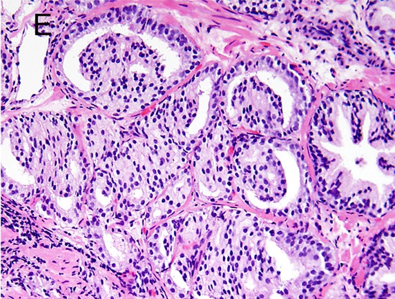 Prostatakarzinom
Gleason-Pattern 4
Prostatakarzinom mit glomeruloidem Wuchsmuster