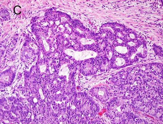 Prostatakarzinom
Gleason-Pattern 4
Prostatakarzinom mit kribriformem Wuchsmuster
