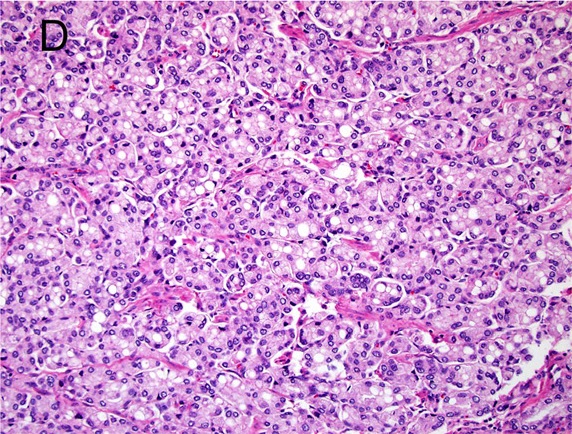 Prostatakarzinom
Gleason-Pattern 4
Prostatakarzinom mit fusioniertem Wuchsmuster