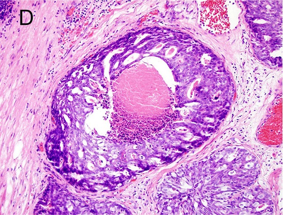 Prostatakarzinom
Gleason-Pattern 5
Prostatakarzinom mit Komedonekrosen